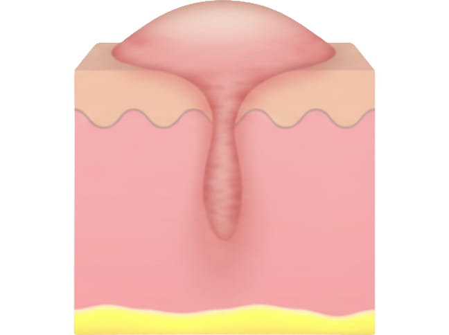 비후성 켈로이드 흉터