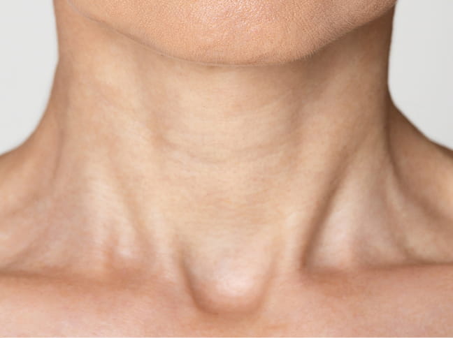 가로 목주름 복원